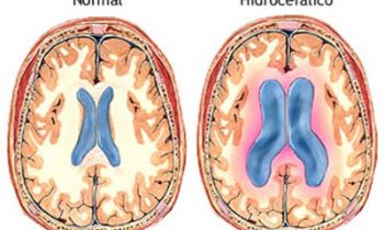 hidrocefalia